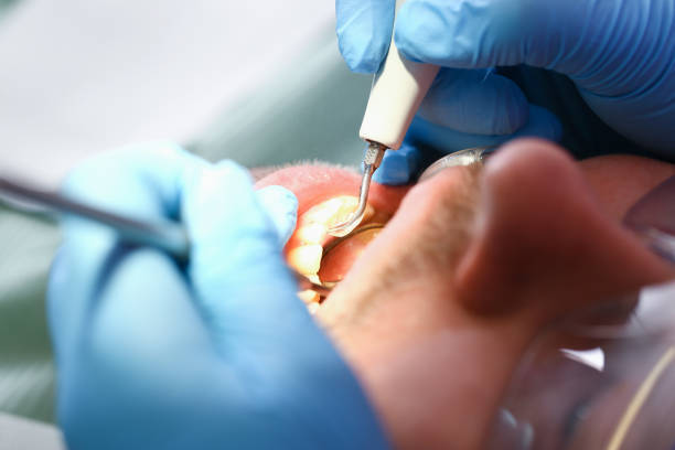 Best Emergency Tooth Extraction in Morris, OK