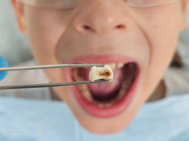 Best Emergency Tooth Extraction in Morris, OK